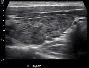 ultrasound thyroid hashimotos thyroiditis nodules followup observations few hypoechoic patchy resolved 2y clearly zones fig above