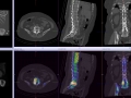 R L45 disc and foraminal impingement on MRI