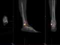 ATFL injury bone scan 0002