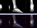 ATFL injury bone scan 0005