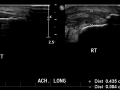 Achilles distal tendinopathy and intrasubstance tear 0005