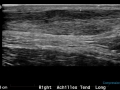 Achilles tendinopathy with neovasc grade 2 0002