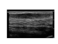 Achilles tendinopathy with neovasc grade 3 edit