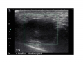 Intermetatarsal Bursitis 1