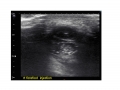 Intermetatarsal Bursitis post inject 1a
