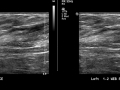 Intermetatarsal web space normal