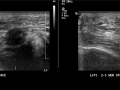 Mortons neuroma confirmed 003