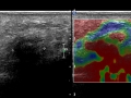 Mortons neuroma with elastography 2