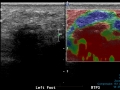 Mortons neuroma  with elastography