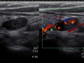 R lower pole PTH on ultrasound study