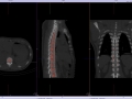 Calcification T10,11 Lig Flavum