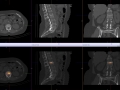 L1 fracture 55yr old