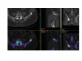 Metastasis 5mm
