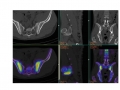 Severe sacroiliitis