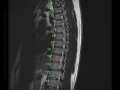 T10,11 lig flavum calcification MRI 0001