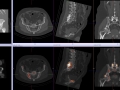facet jt OA ii with SI and hip