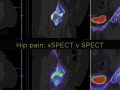 MRI hip comparison xSPECT