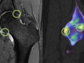 MRI xSPECT hip correlation