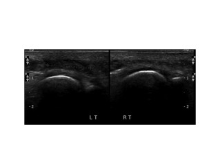 Fig 6. Forefoot Imaging: Adventitial Bursitis on plantar surface metatarsal head. Click to enlarge.