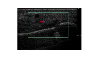 Fig.4 Forefoot Imaging: Stress fracture metatarsal neck. Click to enlarge.