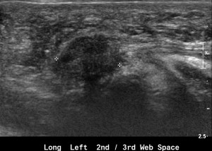 Fig 1. Forefoot Imaging: Morton's Neuroma. Click to enlarge.