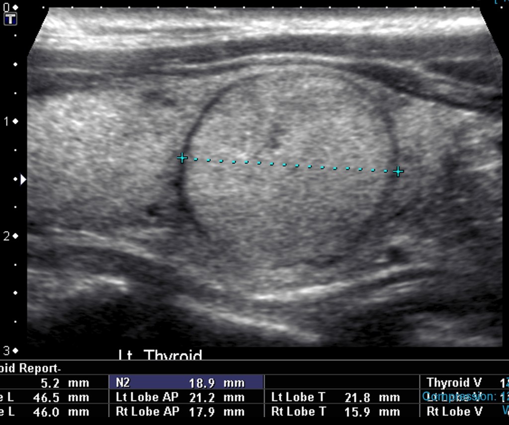 to-biopsy-or-not-the-thyroid-nodule-dilemna-dr-iain-duncan