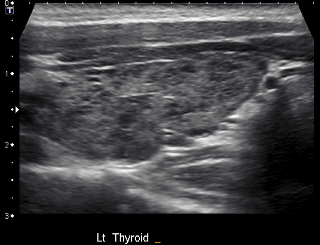 thyroid sonogram