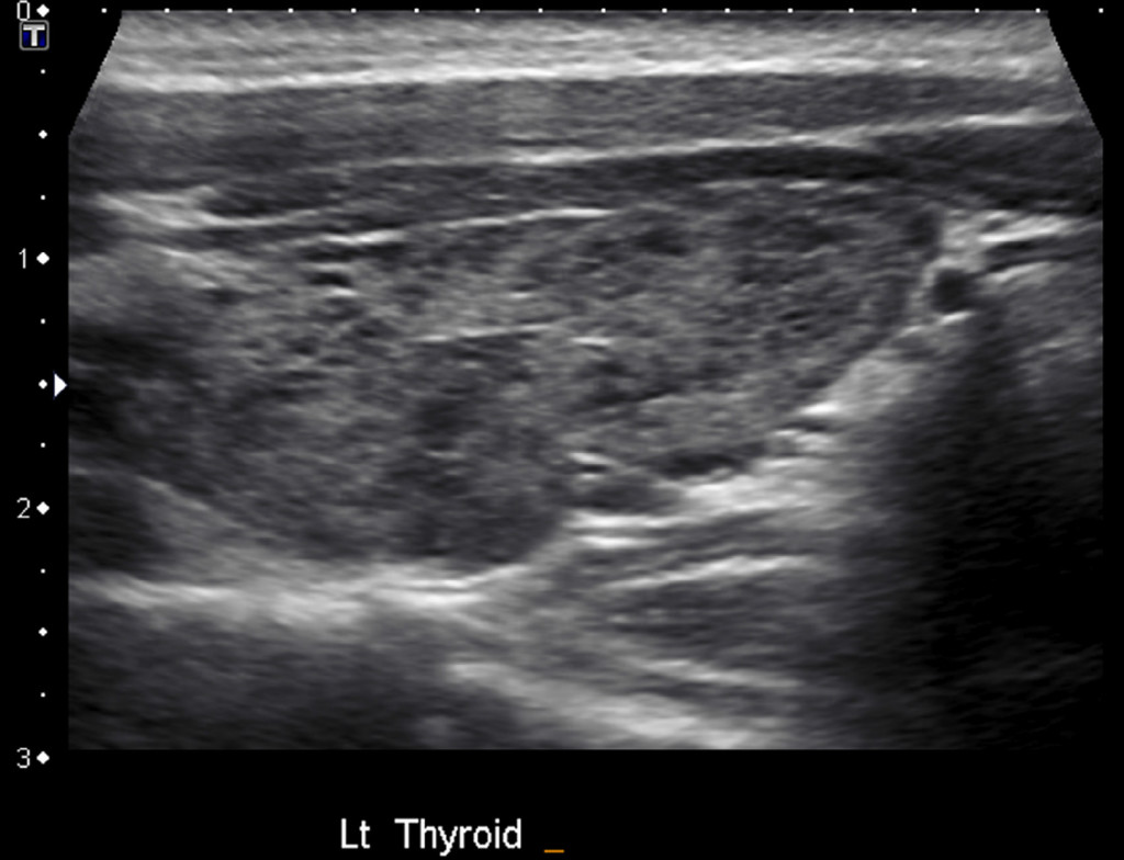 Heterogeneous Thyroid Gland Radiology