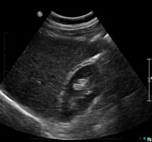 Liver surface ultrasound