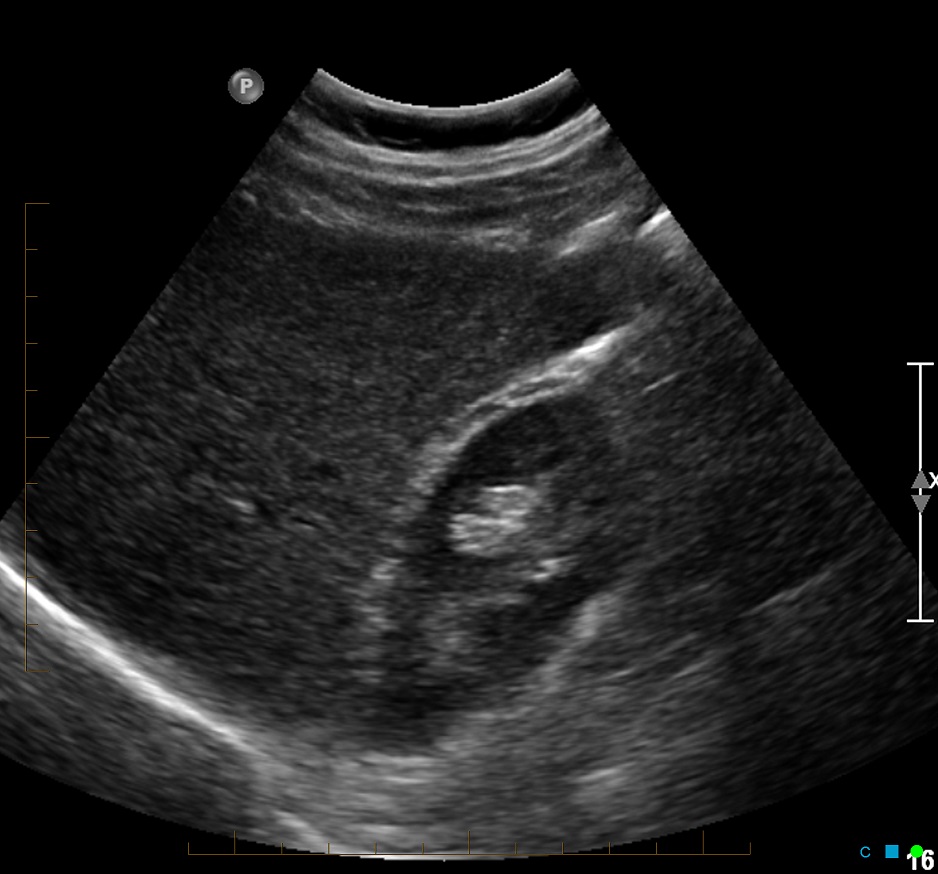 Ultrasound Of Normal Liver