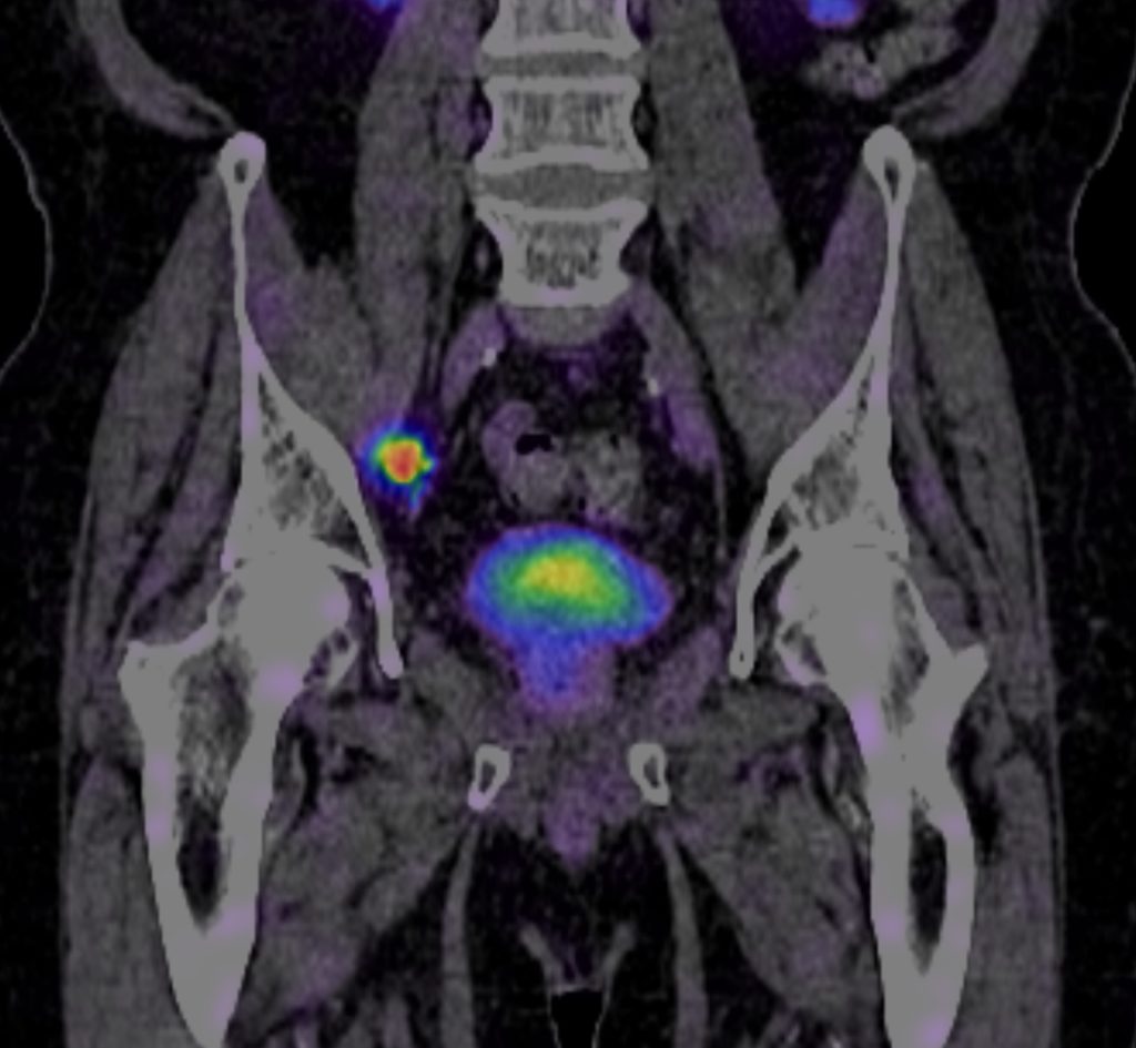 Scan showing spread to a left pelvic lymph node
