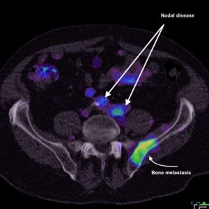 Prostate carcinoma spread in pelvis and para-aortic lymph nodes