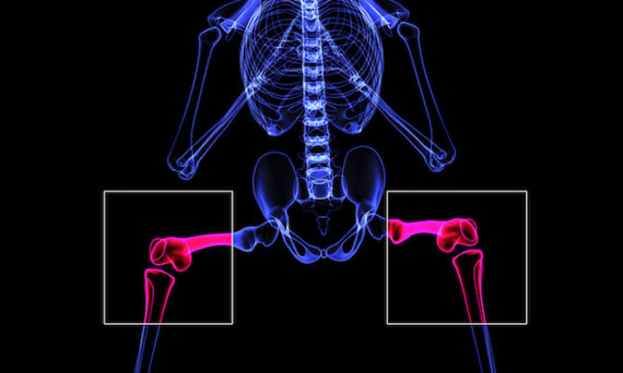PRP for Osteoarthritis knee