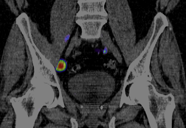Lymph node metastasis on Tc-PSMA scan